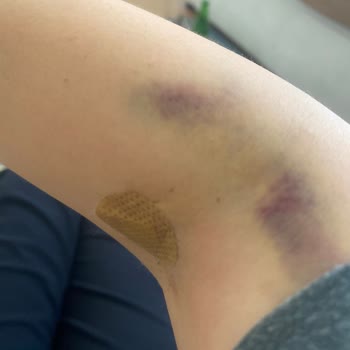 Vera Hastanesi Apandisit Ameliyatı Oldum Ve Sonuç Kötü