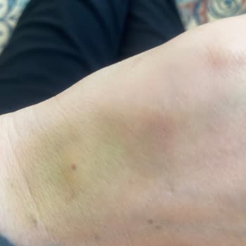 Vera Hastanesi Apandisit Ameliyatı Oldum Ve Sonuç Kötü