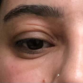 Clinique 100 Saat Nemlendirme Etkili Krem Alerji Yaptı.