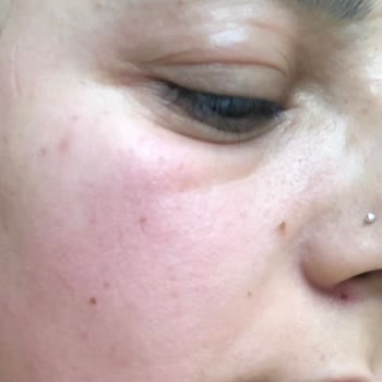 Clinique 100 Saat Nemlendirme Etkili Krem Alerji Yaptı.