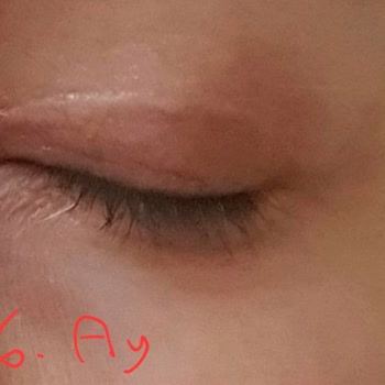 Dilan Polat Estetik Meme Dikleştirme + Protez Ve Göz Kapağı Estetik Mağduru!