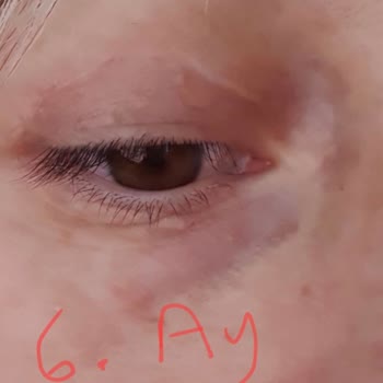 Dilan Polat Estetik Meme Dikleştirme + Protez Ve Göz Kapağı Estetik Mağduru!