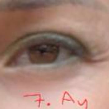 Dilan Polat Estetik Meme Dikleştirme + Protez Ve Göz Kapağı Estetik Mağduru!