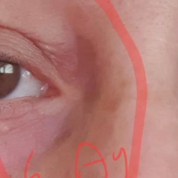 Dilan Polat Estetik Meme Dikleştirme + Protez Ve Göz Kapağı Estetik Mağduru!