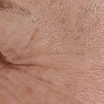 Dilan Polat Estetik Meme Dikleştirme + Protez Ve Göz Kapağı Estetik Mağduru!