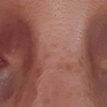 Dilan Polat Estetik Meme Dikleştirme + Protez Ve Göz Kapağı Estetik Mağduru!