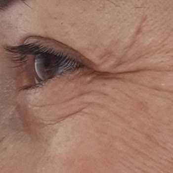 Dilan Polat Estetik Meme Dikleştirme + Protez Ve Göz Kapağı Estetik Mağduru!