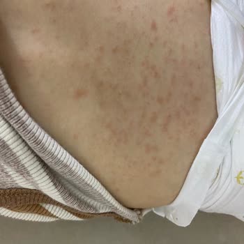 Sebamed Şampuan Alerji Yaptı