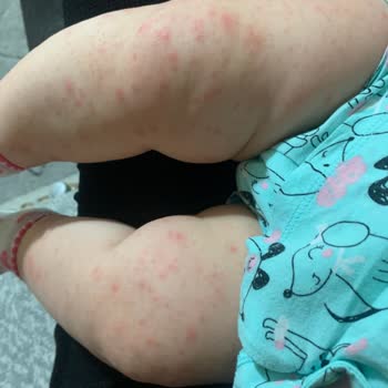 Mustela Güneş Kremi Ve Vücut Losyonu Alerji Yaptı