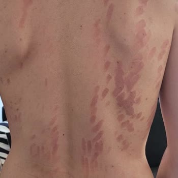 Epiyes Estetik Epilasyonda Yaşanan Yanık!