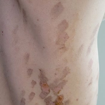 Epiyes Estetik Epilasyonda Yaşanan Yanık!