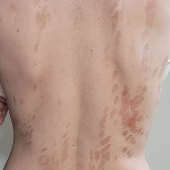 Epiyes Estetik Epilasyonda Yaşanan Yanık!