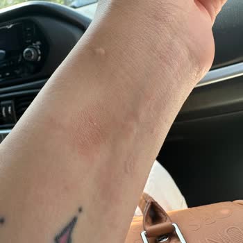 Apple Watch 7 Bileğimi Tahriş Etti