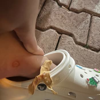 Crocs Terlik & Ayakkabı Terlik Yanlardan Yara Yaptı