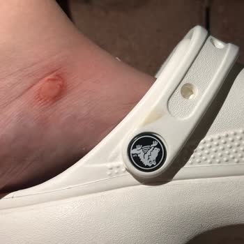Crocs Terlik & Ayakkabı Terlik Yanlardan Yara Yaptı