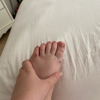 Deichmann Sandalet Ayağıma Yara Yaptı