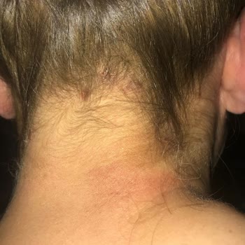 İnanç Mengü Kuaför Açıcı Dan Ötürü Yanık Oluşması