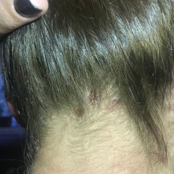 İnanç Mengü Kuaför Açıcı Dan Ötürü Yanık Oluşması