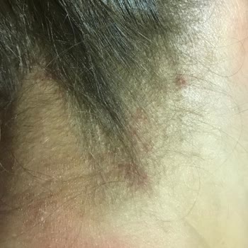 İnanç Mengü Kuaför Açıcı Dan Ötürü Yanık Oluşması