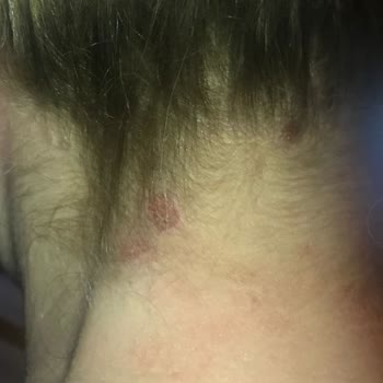 İnanç Mengü Kuaför Açıcı Dan Ötürü Yanık Oluşması