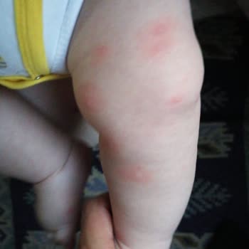 Hipp 1 Organic Combiotic Mama Döküntü Şikayeti