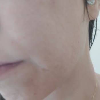 Neutrogena Krem Yüze Verdiği Zarar