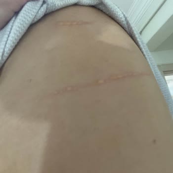 Penti Straplez Sütyen Vücudumu Tahriş Etti Su Topladı