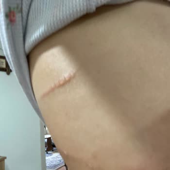 Penti Straplez Sütyen Vücudumu Tahriş Etti Su Topladı