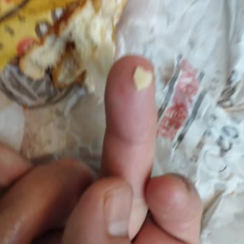 Burger King Hamburgerden Yabancı Cisim Çıktı!