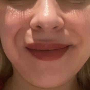 Prof. Dr. Filiz Canpolat Masseter Botoks Ve Nazolabial Dolgu Faciası