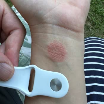 Apple Watch Bileğimi Yaktı