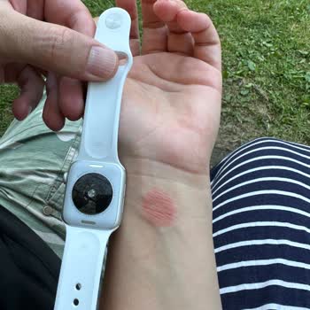 Apple Watch Bileğimi Yaktı