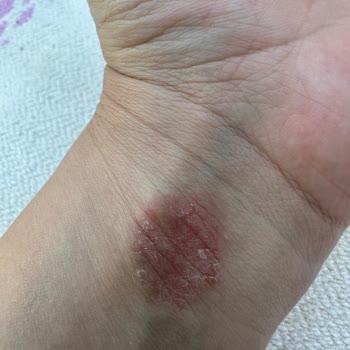 Apple Watch Bileğimi Yaktı