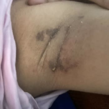 Medicana Hospitals Bursa'da Lazerde Yakıldım