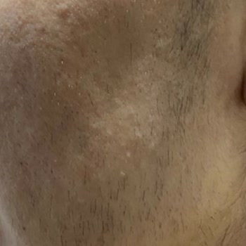 Malatya Neslim Güngen Lazer Epilasyon Mağduriyeti