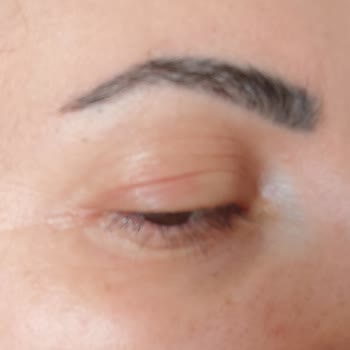 Maruderm Serum Alerji Yaptı