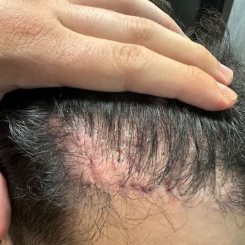 Arenamed Saç Ekimi Pişmanlığı