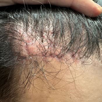 Arenamed Saç Ekimi Pişmanlığı