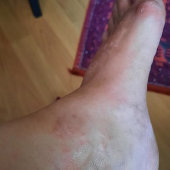 Gratis Bee Beauty Ayak Maskesi Mağduriyeti