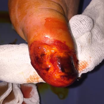 Echomar Doktor İhmali Sonucu