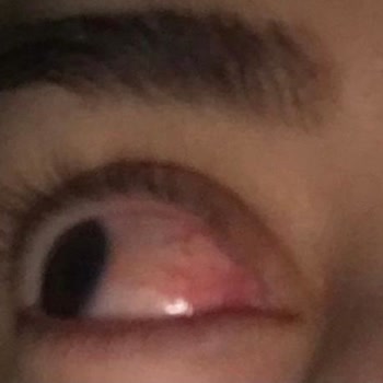 Derminix Marka Makyaj Temizleme Yağı Göz Yakıyor Tahriş Ediyor!