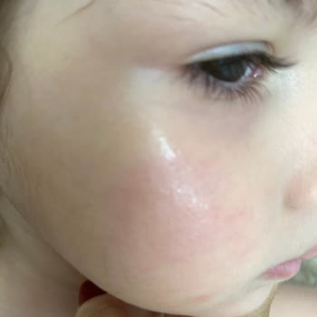 Mustela Baby Kızımın Yüzünü Yanık Gibi Tahriş Etti