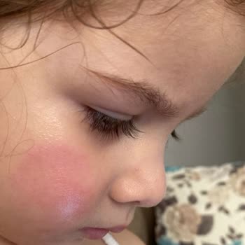 Mustela Baby Kızımın Yüzünü Yanık Gibi Tahriş Etti