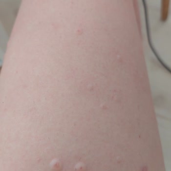 Agiss Tüy Dökücü Krem Şikayeti