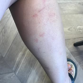 La Beaute By Buse Genç Bacak Lazer Epilasyonunda Yanık!