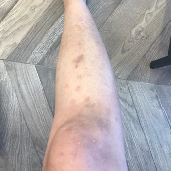 La Beaute By Buse Genç Bacak Lazer Epilasyonunda Yanık!