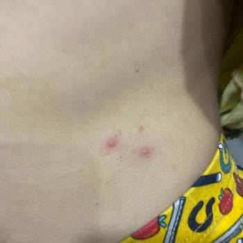 Mustela Stelatopia Duş Jeli Sivilcelenme Problemi!