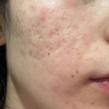 Watsons Ankara Forum AVM'de Satılan İmew No 2 Serum Alerji Yaptı!