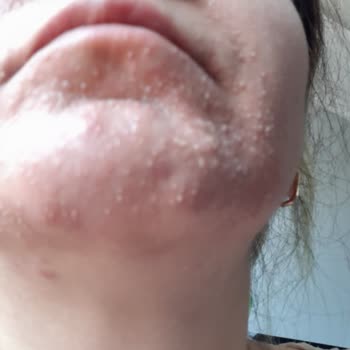 Neutrogena Skin Detoks Serinletici Yüzümü Yaktı Alerji Yaptı