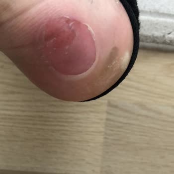 Papuckoolik (İnstagram) Papuckoolik Ayaklarımı Yara İçinde Bıraktı